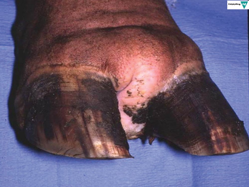 A foot affected by a very large interdigital fibroma or corn. 