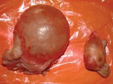 A polycystic ovary (left) compared with a normal ovary (right) from a cow.