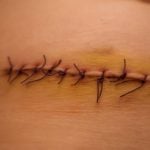 The issue with scar tissue