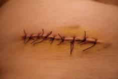 Post-Surgical Skin Stitches Close-Up on Healing Wound with Bruising. Kateryna Tarasenko/iStock/Getty Images